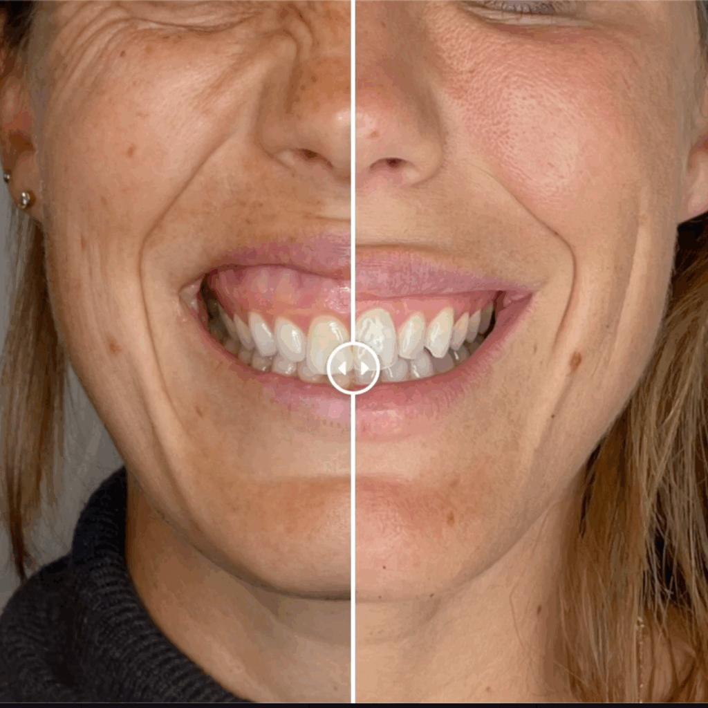 acido hialuronico sonrisa gingival dra mercedes lamela las palmas maspalomas