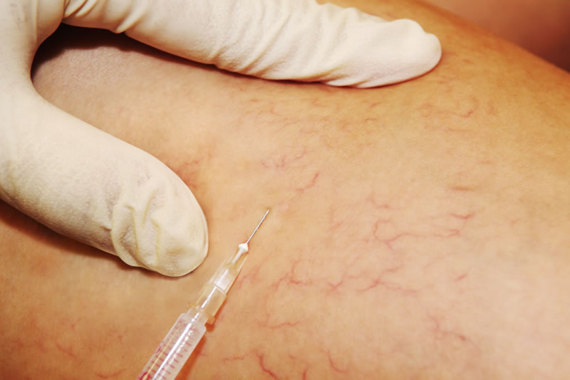 escleroterapia dra mercedes lamela las palmas maspalomas