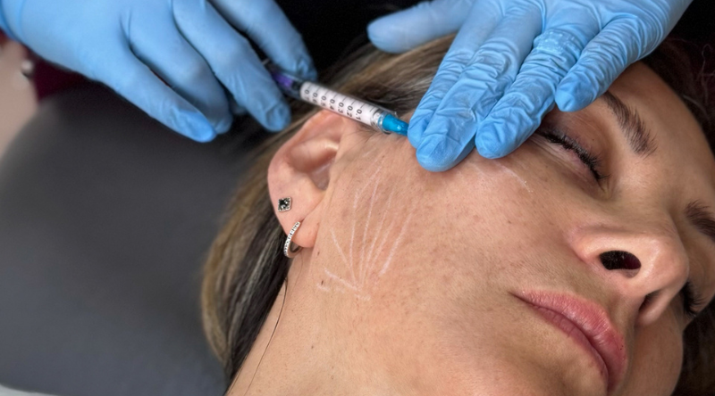 inductores de colageno dra mercedes lamela las palmas maspalomas