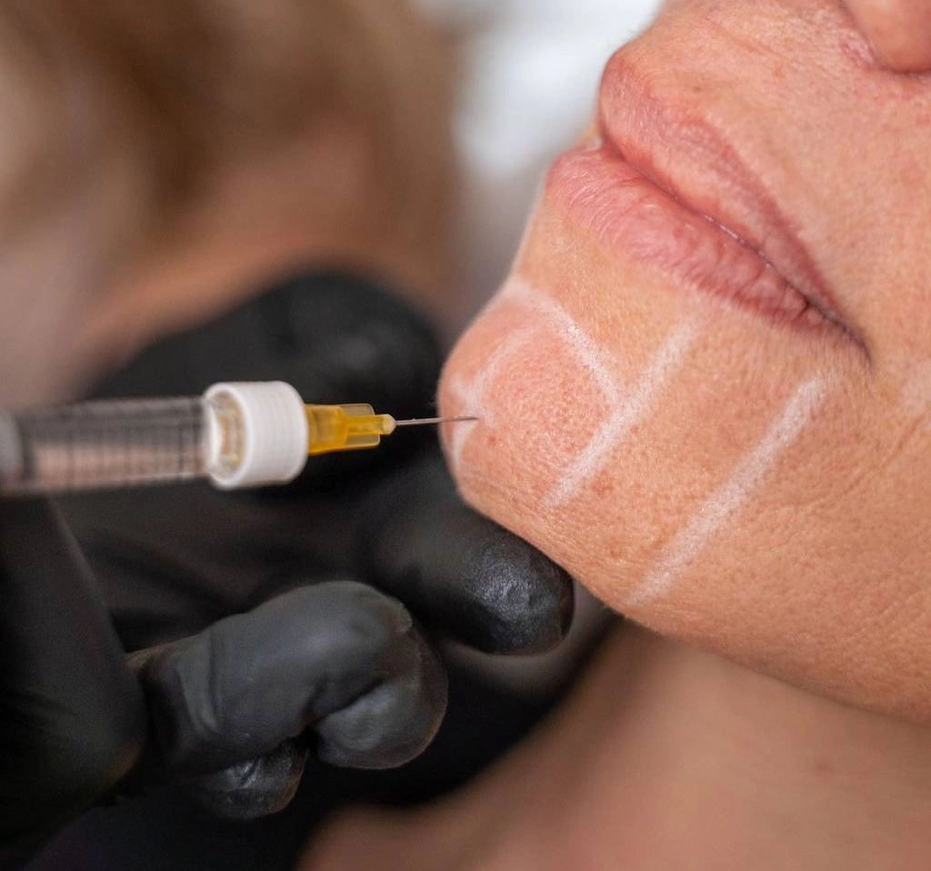 acido hialuronico menton dra mercedes lamela las palmas maspalomas